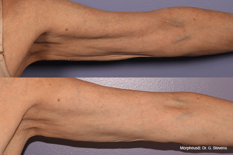 arm before and after Optimas treatment