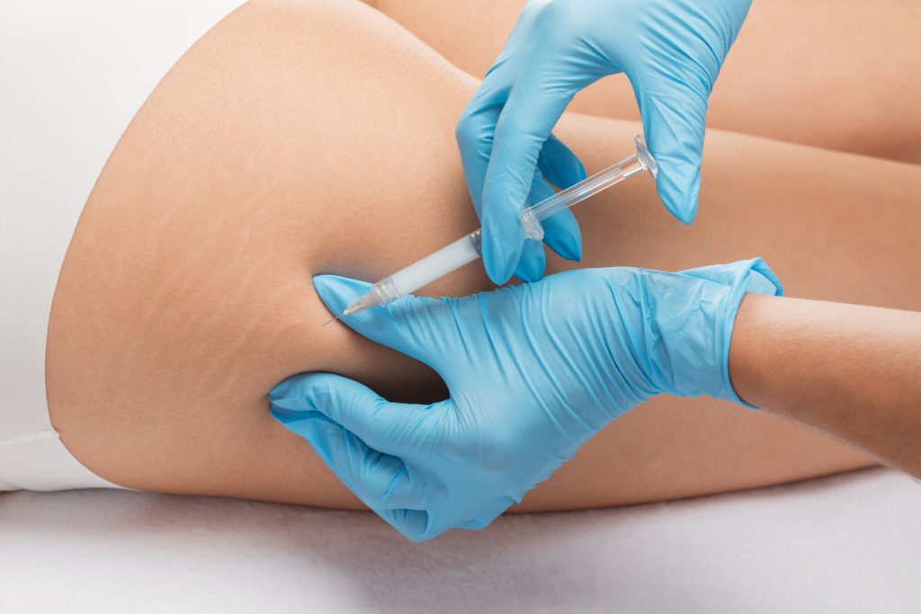 photo of woman getting qwo cellulite injection treatment