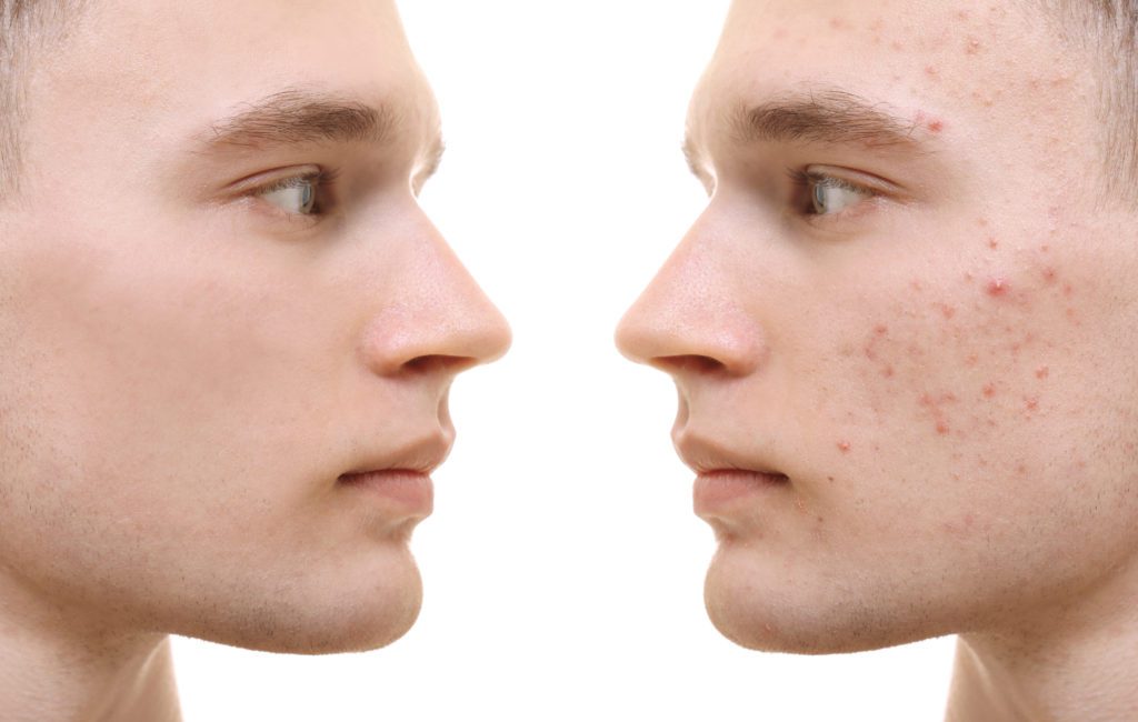 photo of young man before and after laser acne treatment