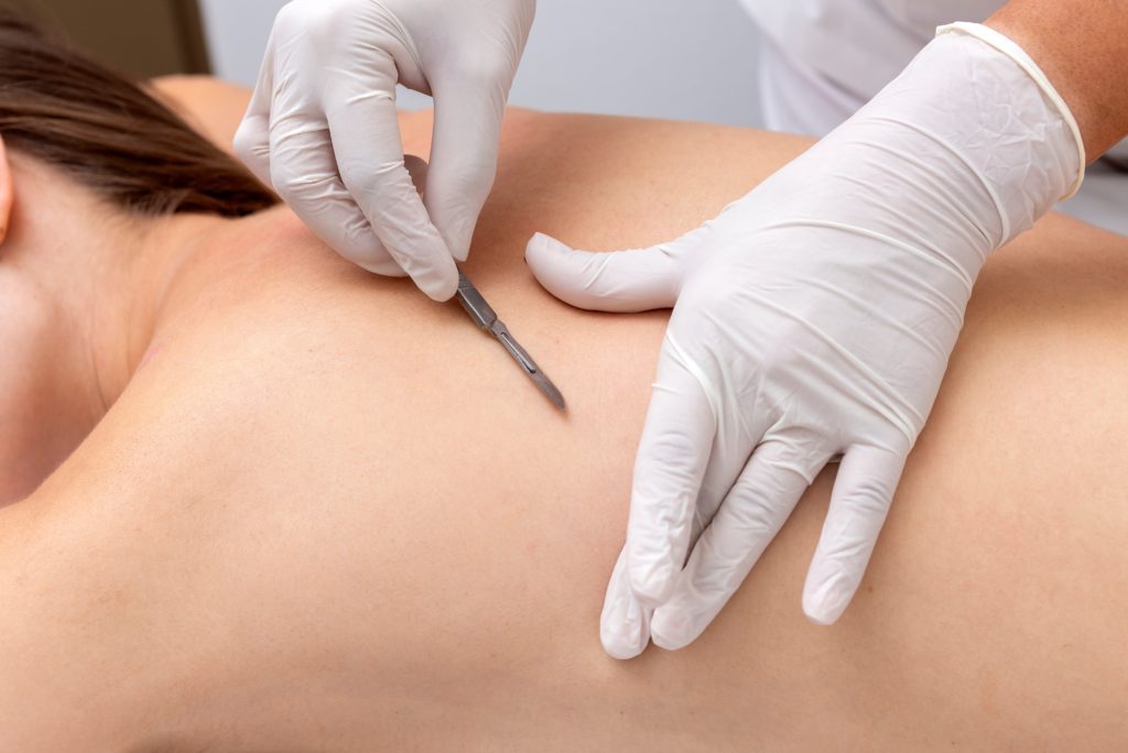 woman receiving dermaplaning treatment on her back