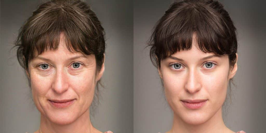 photo of facial lines before and after treatment
