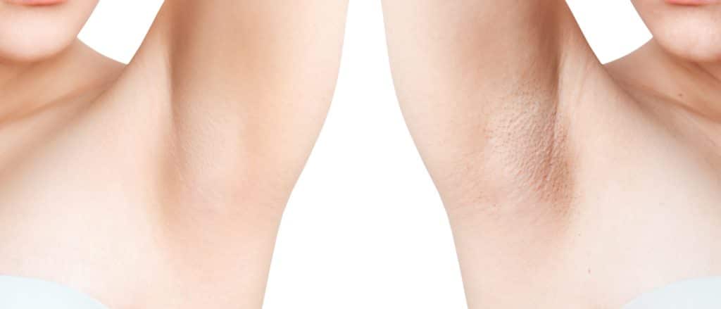 photo of before and after ingrown armpit hair treatment