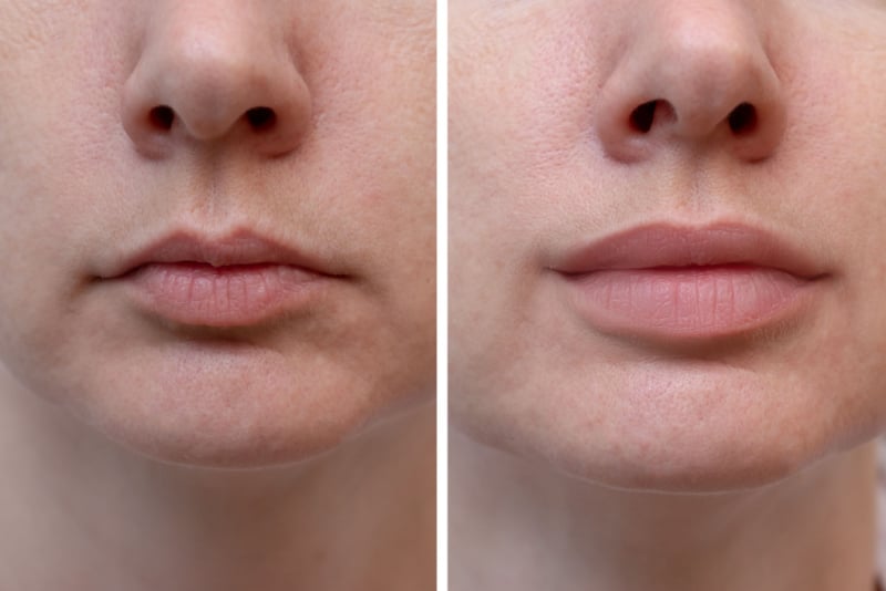 photo of lips before and after treatment