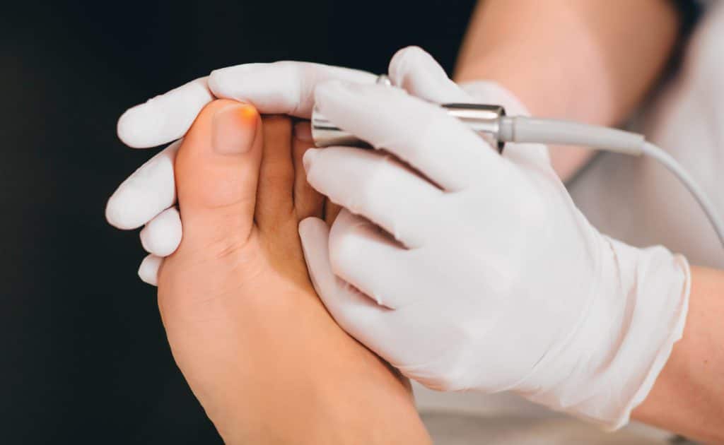 photo of person getting laser nail fungus treatment