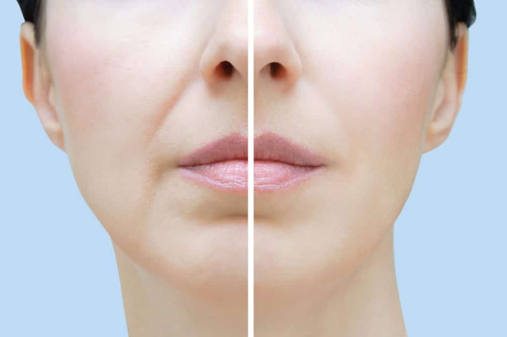 woman before and after nasolabial fold treatment