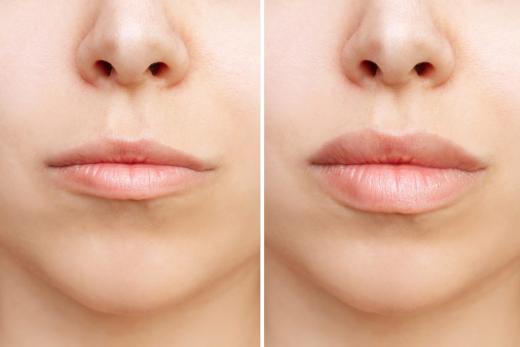 photo of thin lips before and after treatment