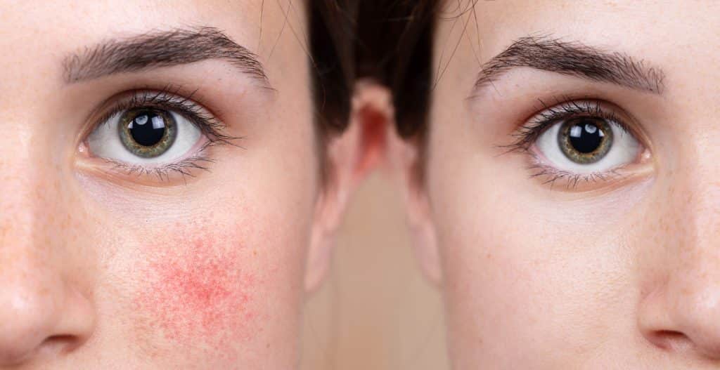 photo of facial skin redness before and after treatment