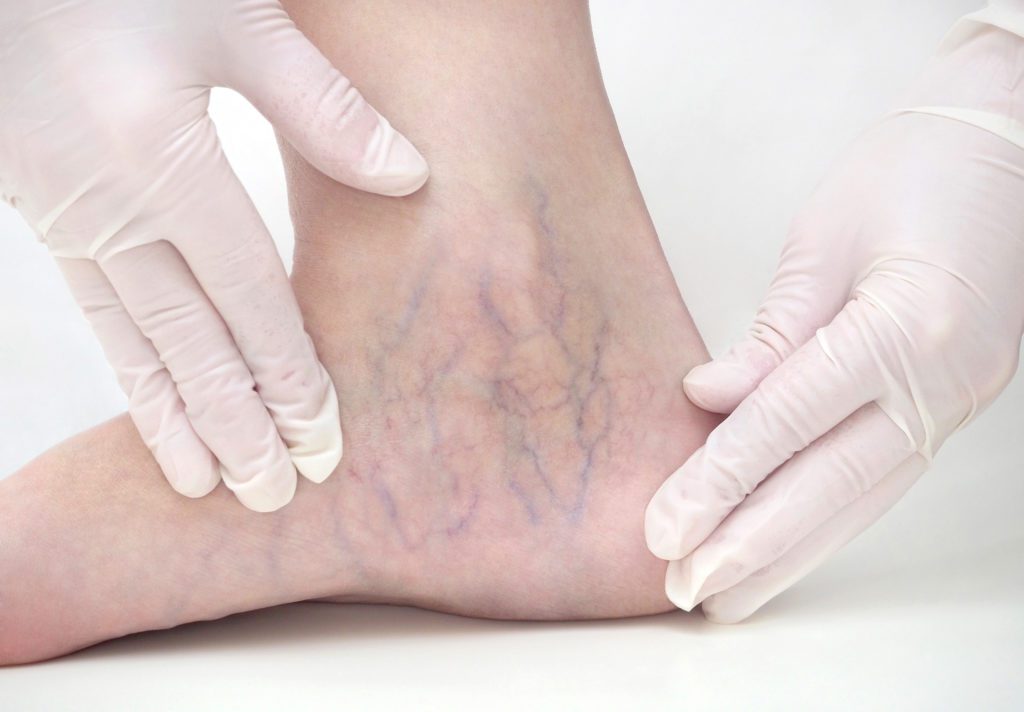 photo of woman with spider veins on her ankle