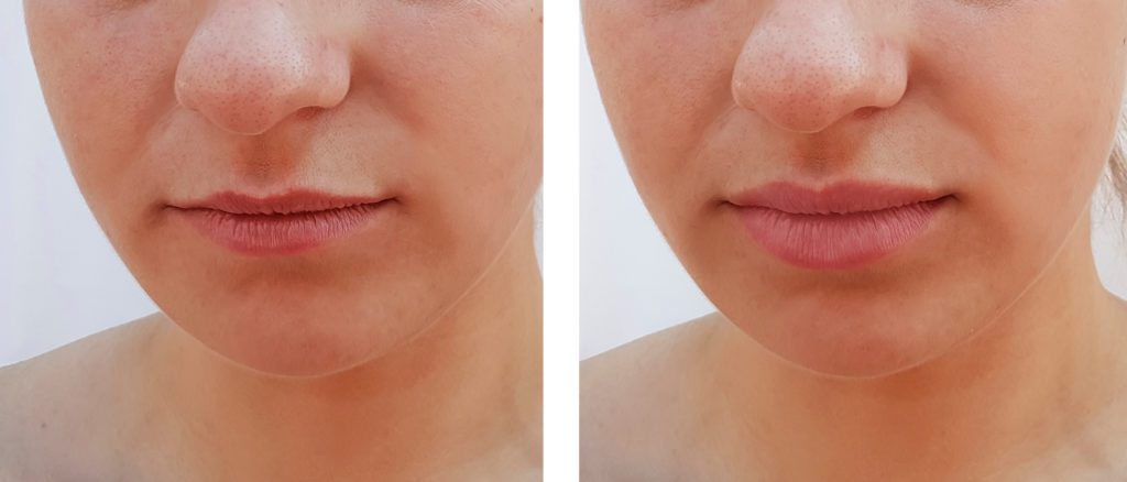 photo of thin lips before and after