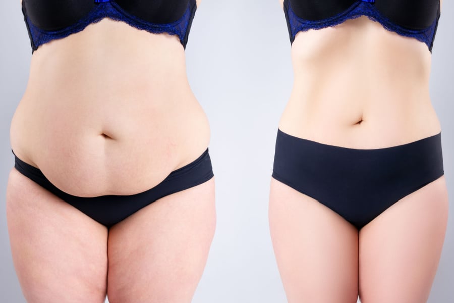 Before and after tummy flattening procedure