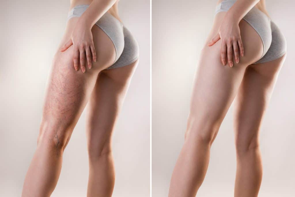photo of leg veins before and after treatment