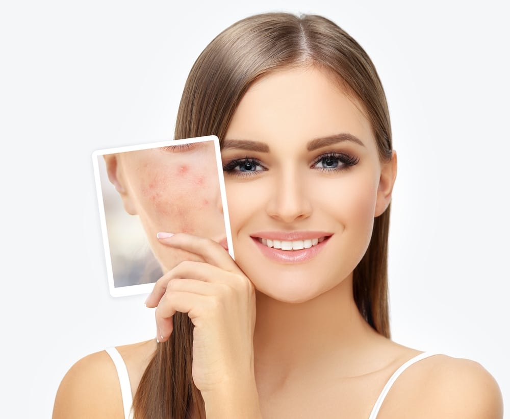 Acne Treatment | Ageless Skin Rejuvenation