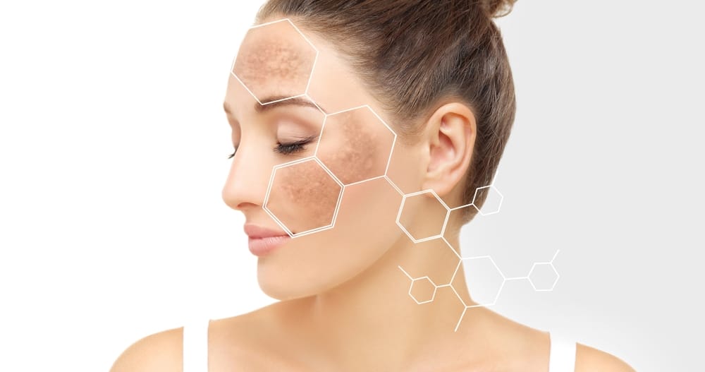 Sun Damage and Hyperpigmentation | Ageless Skin Rejuvenation