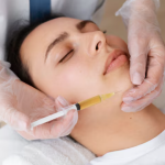 Plasma for Acne Scars